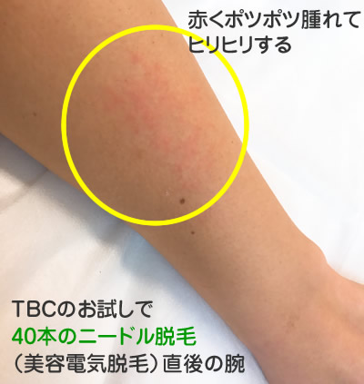 TBCの美容電気脱毛は痛い